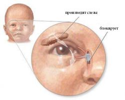 Непроходимость слезного канала у новорожденных. Признаки и методы лечения дакриоцистита