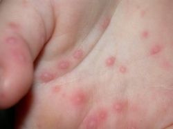Грибок на руках: симптоматика и способы лечения заболевания