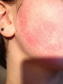Красное пятно на лице: причины появления и методы борьбы
