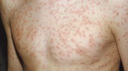 Как работают прививки от краснухи?