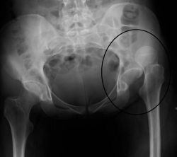 Врожденный вывих бедра: причины, симптомы, лечение, последствия, рекомендации врачей