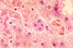 Вирусный гепатит A: пути передачи, симптомы, диагностика, лечение и профилактика