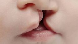 Волчья пасть у человека: лечение и коррекция