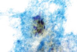 Геморрагический диатез: классификация, причины, симптомы и лечение, клинические рекомендации