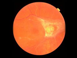 Диабетическая ретинопатия: причины, симптомы и лечение