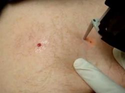 Гемангиома кожи: фото, причины возникновения, симптомы и лечение