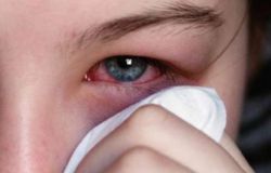 Герпес на глазах: причины, симптомы, фото, методы лечения