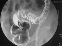 Дивертикулез сигмовидной кишки: причины, симптомы, лечение и осложнения