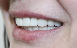 Зубные бюгельные протезы: отзывы и фото