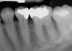 Глубокий кариес: виды, причины, основные симптомы, диагностика и особенности лечения