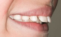 Глубокий прикус: причины, симптомы, диагностика и особенности лечения