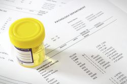 Гемоглобин в моче: что это значит? Причины и признаки нарушения, норма