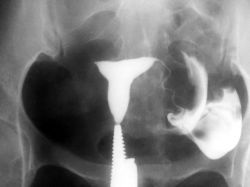 ГСГ маточных труб: подготовка, описание процедуры, показания и противопоказания, последствия, отзывы