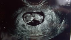 Гинекологическое УЗИ: на какой день цикла делают, показатели нормы, расшифровка результатов