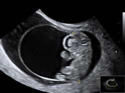 Скрининг 1 триместра: зачем и как он проводится