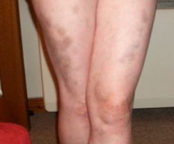 Синяки на ногах: причины и последствия