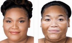 Лечение витилиго народными средствами: несколько эффективных методов