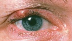 Как вылечить ячмень, не прибегая к помощи врачей. Дельные советы