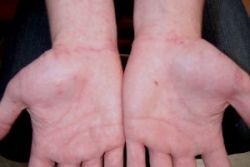 Выраженный кожный зуд: причины