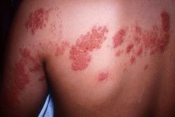 Герпес зостер (опоясывающий лишай): причины, симптомы и методы лечения 