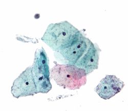 Как проводится лечение трихомониаза у женщин