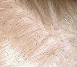 Лечение вшей. Симптомы педикулёза 