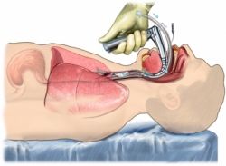 Насколько опасна дыхательная недостаточность?