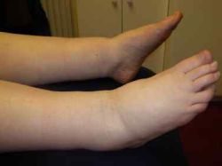 Опухла нога. Причины и лечение