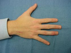 Перелом фаланги пальцев