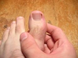 Что делать, если нарывает палец?