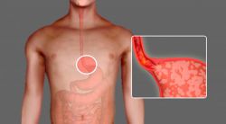 Ахалазия кардии: причины, симптомы, диагностика и лечение