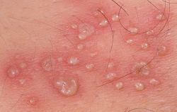 Лечение опоясывающего лишая в домашних условиях