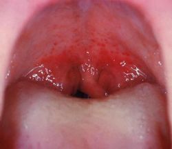 Что такое фарингит? Симптомы, лечение заболевания 