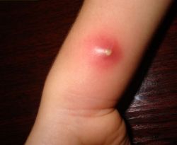 Как лечить фурункулы в домашних условиях