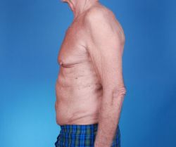 Поддается ли послеоперационная грыжа лечению? 