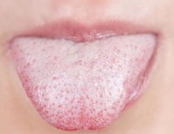 Если болит язык, что делать?