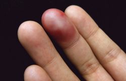 Ушиб пальца: первая помощь и дальнейшее лечение