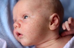 Правильное лечение потницы у новорожденных