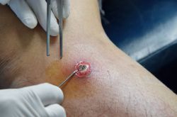 Абсцесс – это что такое и почему возникает? Симптомы и лечение абсцесса