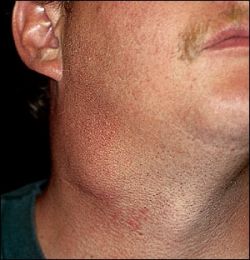 Увеличены лимфоузлы на шее - о чем это может говорить?