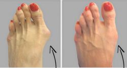 Hallux Valgus: причины и симптомы, лечение, операция, отзывы