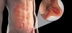 Бедренная грыжа - причины, симптомы, диагностика и особенности лечения