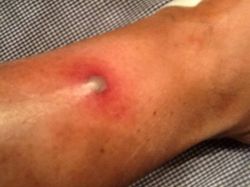 Лечение фурункула в домашних условиях: три эффективных метода