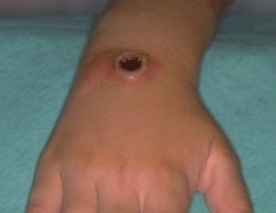 Что такое анаэробная инфекция