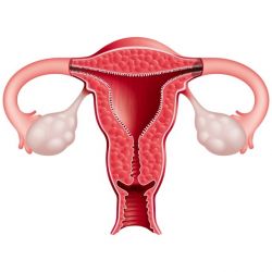 Что такое аднексит: симптомы, методы лечения