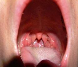 Консультация специалиста: симптомы и лечение ларингита