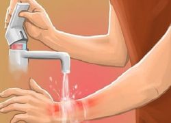 Лечение ожогов в домашних условия народными средствами