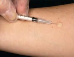 Палочка Коха - возбудитель туберкулеза