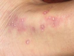 Болезнь Дего: чем она опасна?