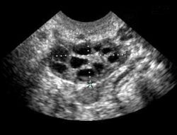 Кистома левого яичника: причины, симптомы и лечение